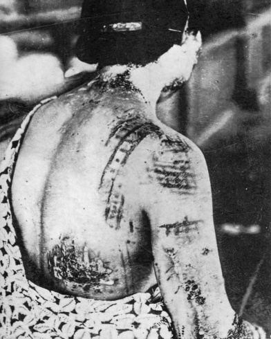 Éric Manigaud, "Gonichi Kimura, Motifs de kimono incrustés par brûlure dans la peau, premier hôpital militaire d’Hiroshima, vers le 15 août 1945", 2019